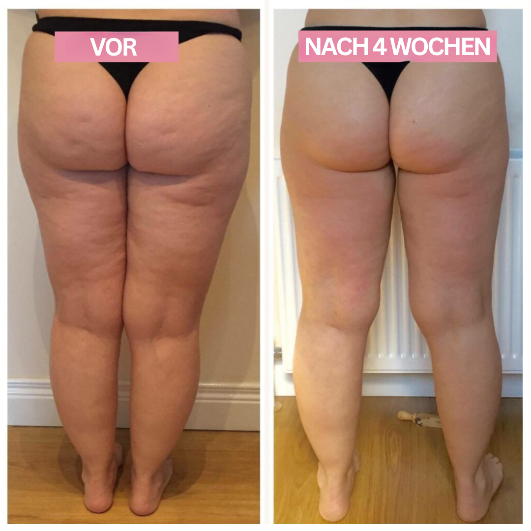Anti-Cellulite Cupping Gerät für Zuhause 7