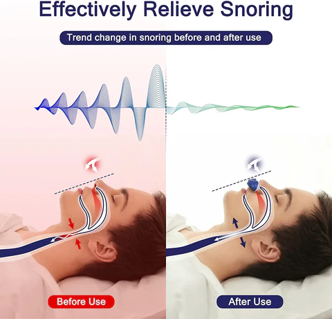 Mikro-CPAP Gerät für maskenlose Schlafapnoe-Behandlung 3