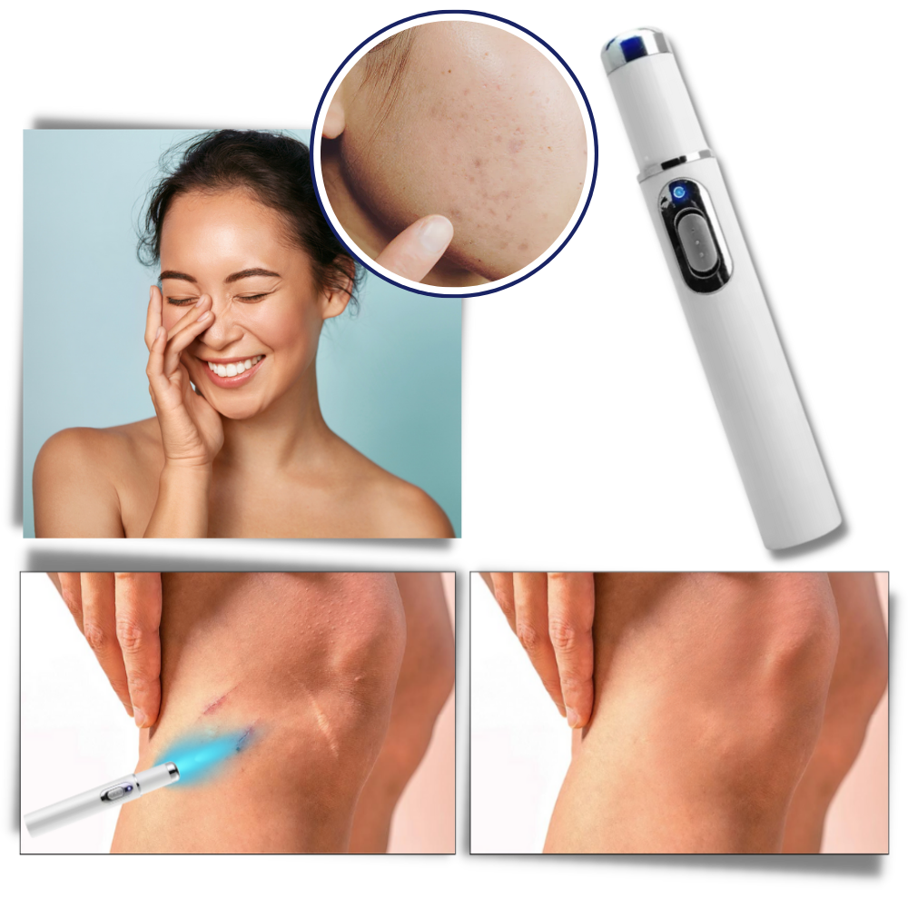 Tragbare Lasertherapie für einen strahlenden Teint 1