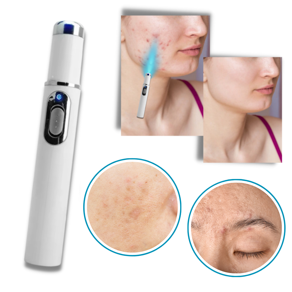 Tragbare Lasertherapie für einen strahlenden Teint 4