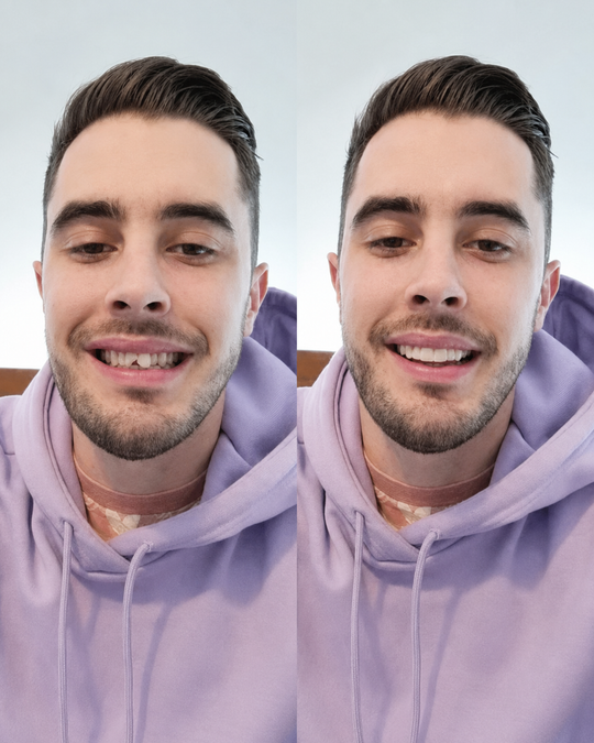 Veneers für ein strahlendes Lächeln - Ober- und Unterkiefer