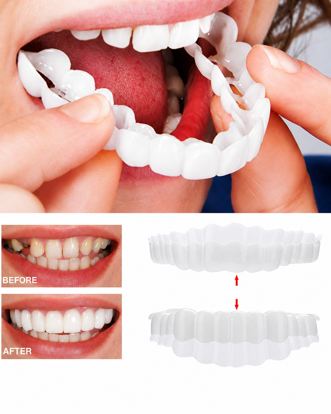 Veneers für ein strahlendes Lächeln - Ober- und Unterkiefer